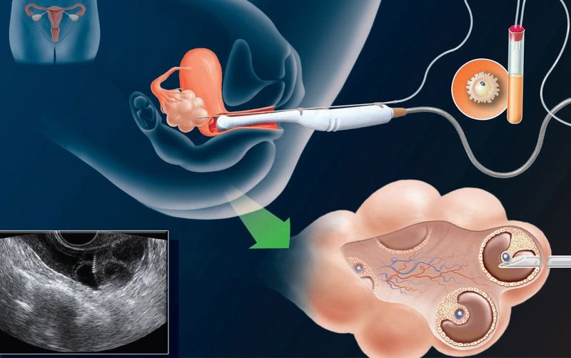 Экстракорпоральное оплодотворение