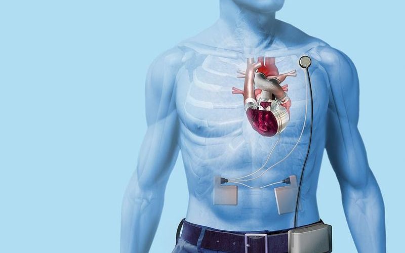 Сердечный протез AbioCor