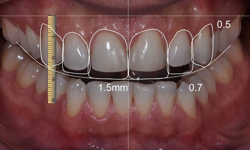 Компьютерное моделирование зубных коронок