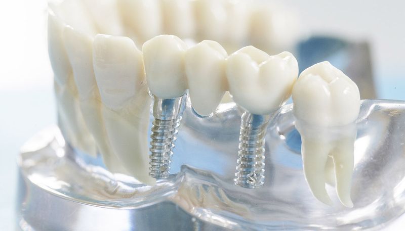 Импланты зубов для одноэтапной формы