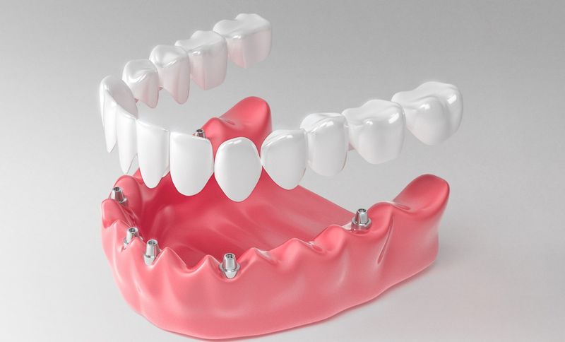 Двухэтапная методика имплантации