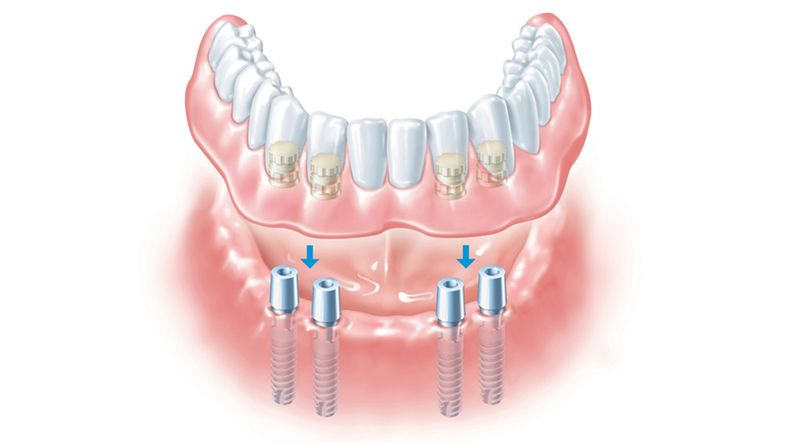 Внутрислизистая форма имплантации