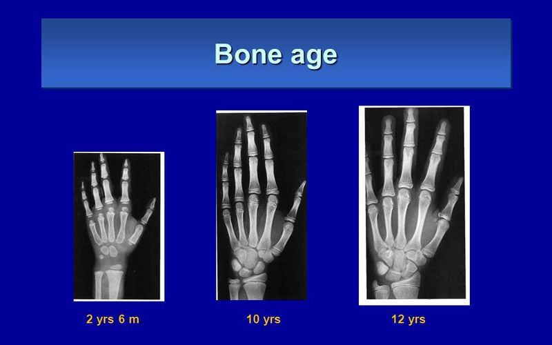 X-Ray Exam: Bone Age Study