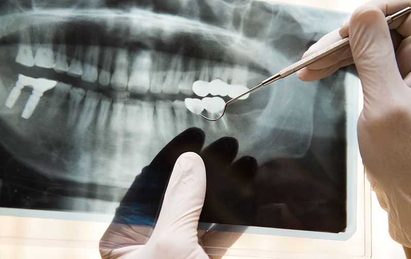 Натуральные зубные импланты