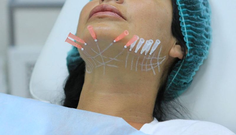 Батутный лифтинг