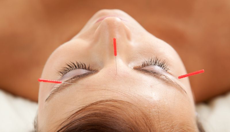Косметологическая акупунктура