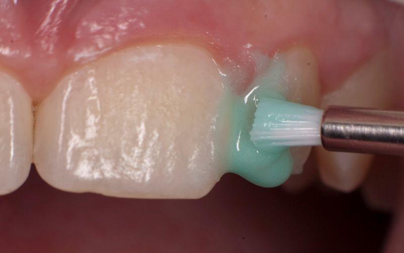 Лечение зубов препаратом ICON