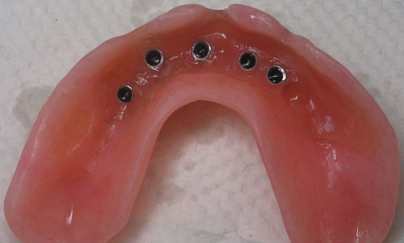 Внутрислизистые протезы