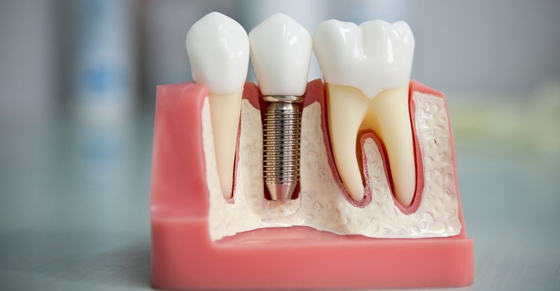 Новые материалы для имплантации зубов