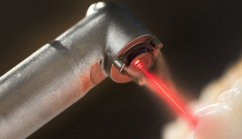 Лазерная технология лечения кариеса