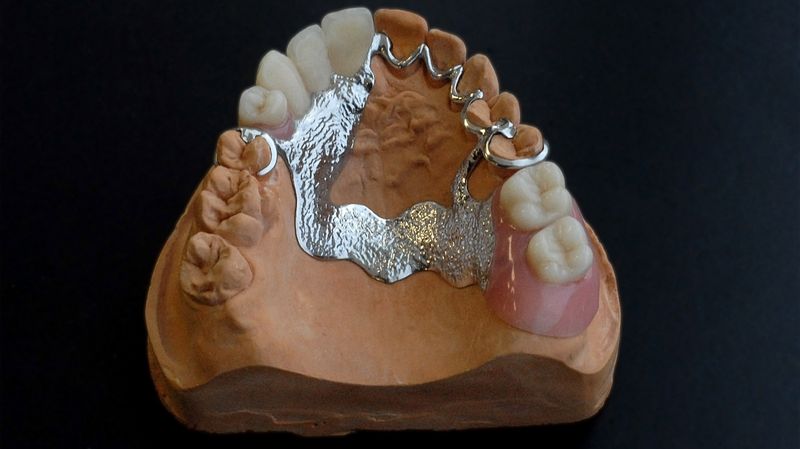 Бюгельные протезы для зубов