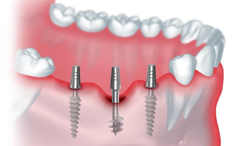 Базальная имплантация