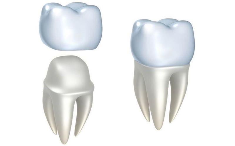 Коронки CAD/CAM