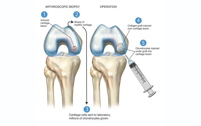 Восстановление хрящей