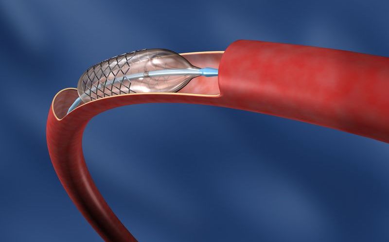 Баллонная ангиопластика
