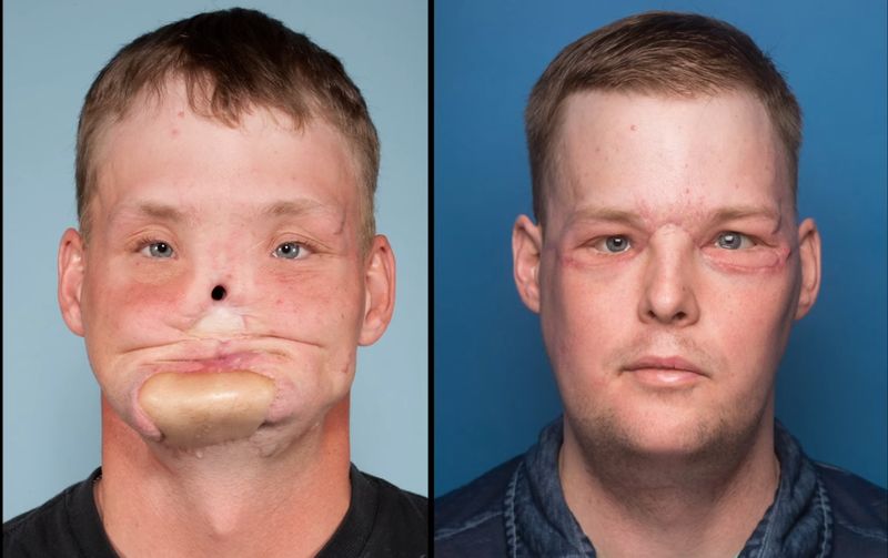 Пересадка лица