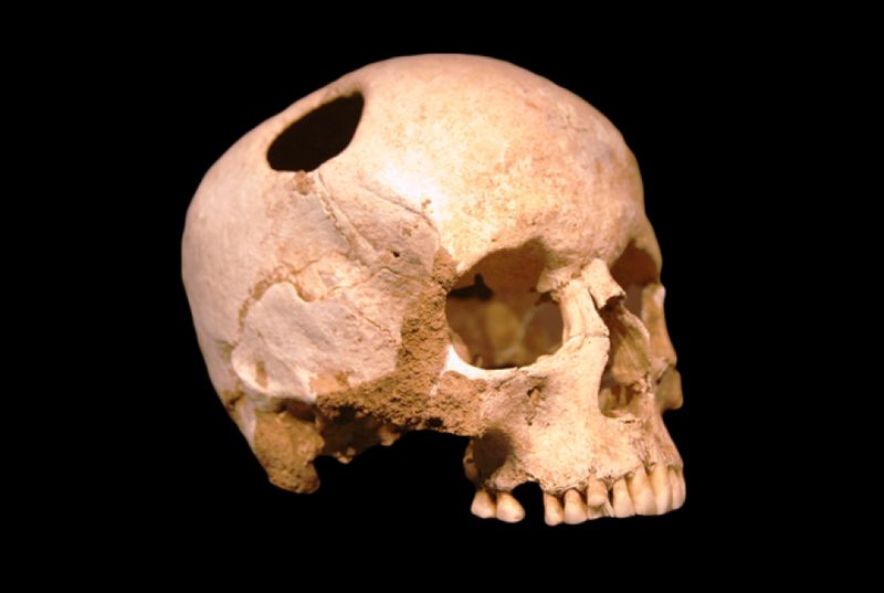 Древний череп со следами трепанации
