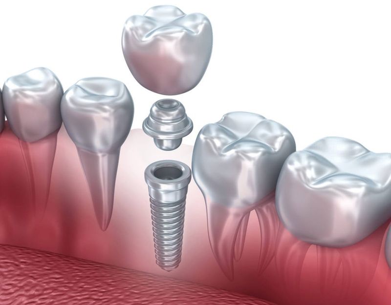 Одномоментная форма протезирования