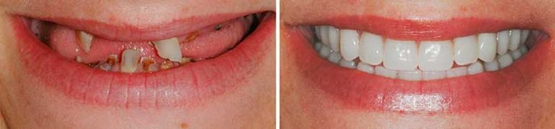 Способ протезирования «все на четырех»