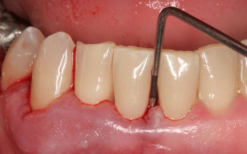 Противопоказания для технологии All-on-4