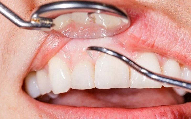 Показания для протезирования