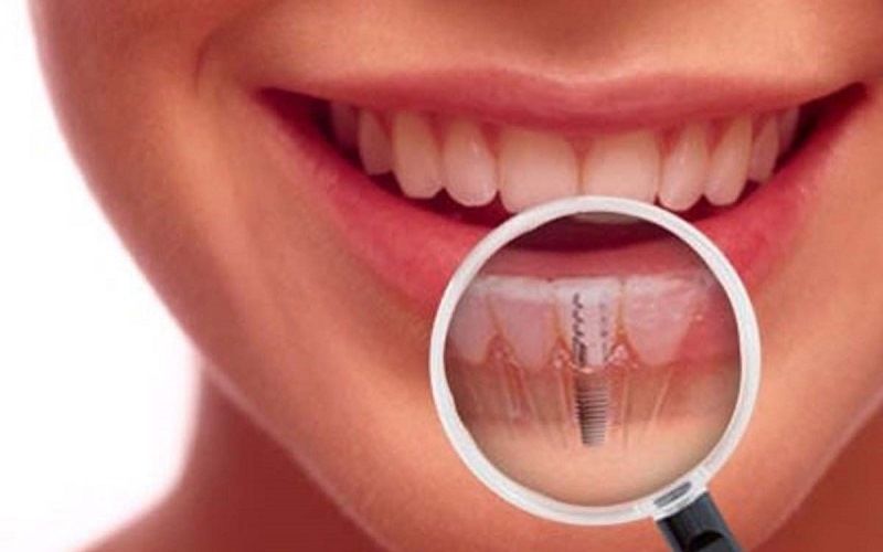 Преимущества методики All-on-4