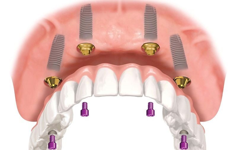 Установка мульти-юнитов